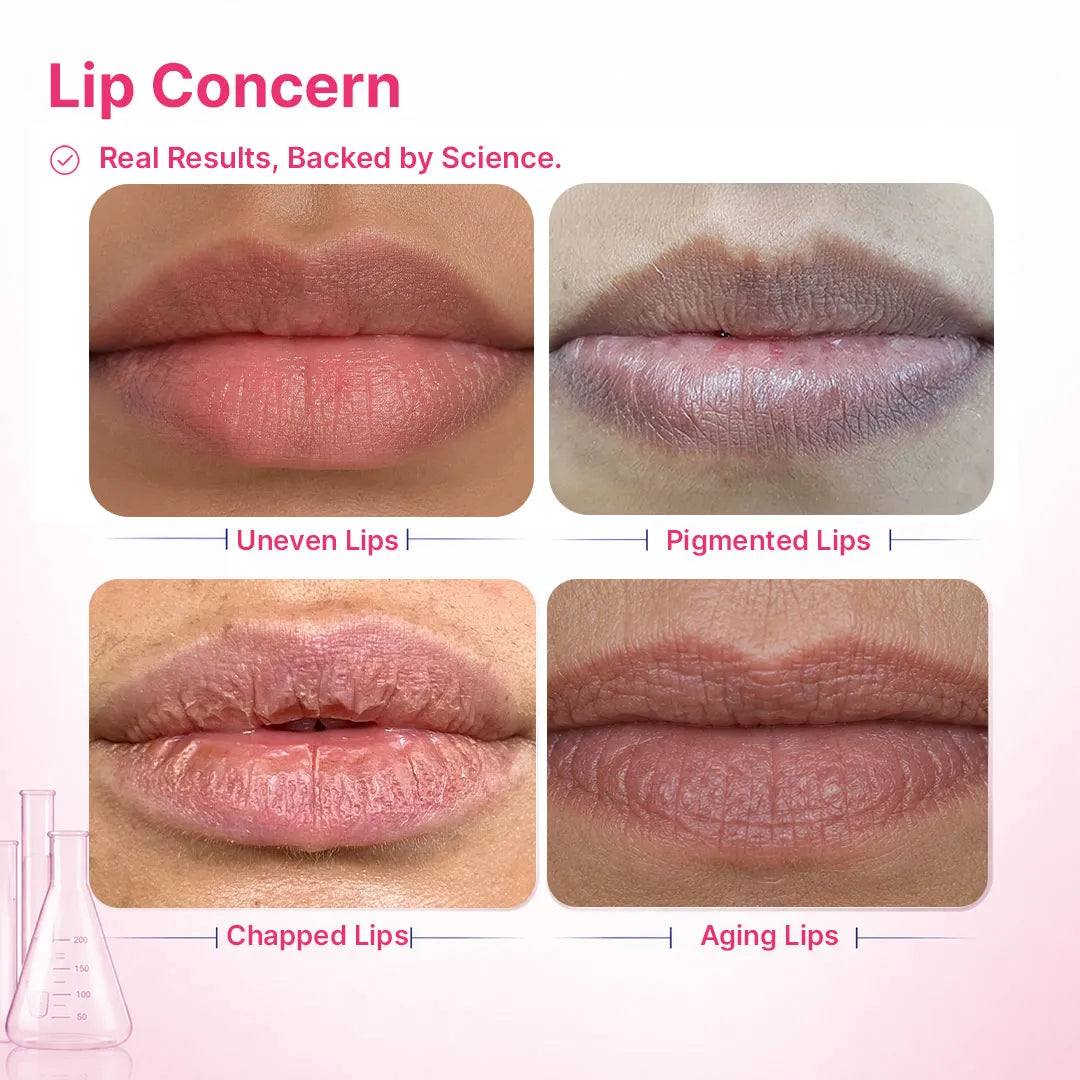 Lip Pigmentation Treatment Kit | 4-Step | Women
